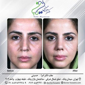 جراحی بینی - دکتر امرالله حسینی 