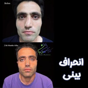 انحراف بینی + دکتر امرالله حسینی