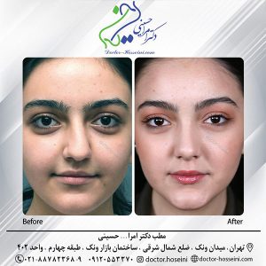 نمونه کار بهترین دکتر عمل بینی در تهران - دکتر امرالله حسینی 