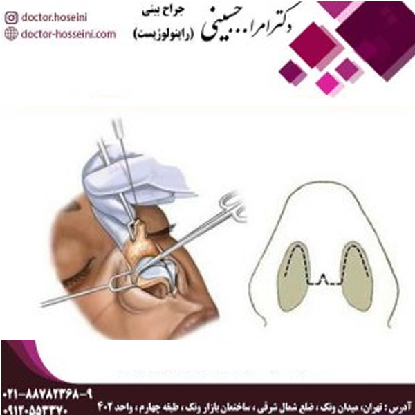 عمل بینی به روش باز بسته - دکتر حسینی - doctor-hosseini.com