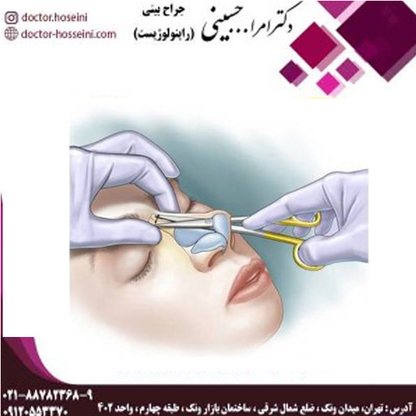 عمل بینی با تکنیک باز و بسته - دکتر امراله حسینی - doctor-hosseini.com