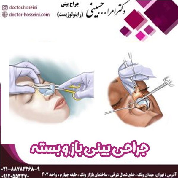 جراحی بینی باز و بسته - دکتر امرالله حسینی - doctor-hosseini.com