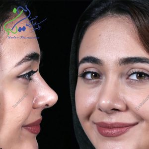 عکس جراحی بینی - دکتر امرالله حسینی - doctor-hosseini.com