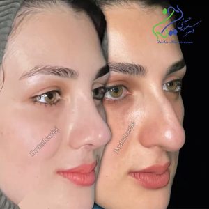 عکس جراحی زیبایی بینی - دکتر امراله حسینی - doctor-hosseini.com