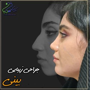 عکس رینوپلاستی استخوانی - دکتر امراله حسینی