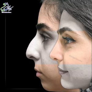 عکس عمل بینی استخوانی - دکتر امراله حسینی