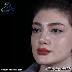 کانتورینگ در بینی گوشتی