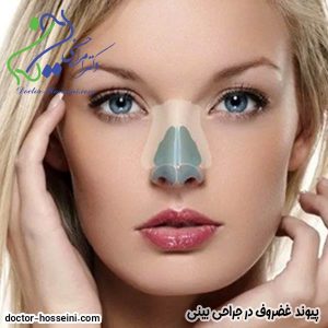 پیوند غضروف در جراحی بینی