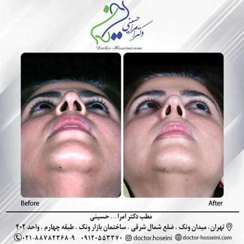 rhinoplasty-670