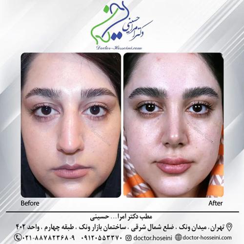 rhinoplasty-671