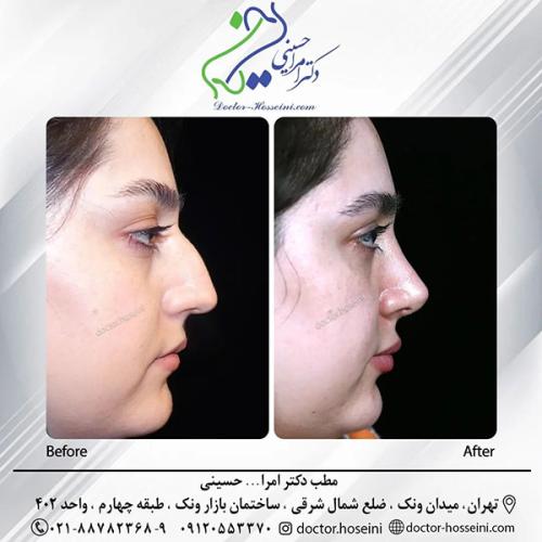 rhinoplasty-672