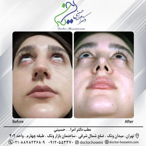 rhinoplasty-673