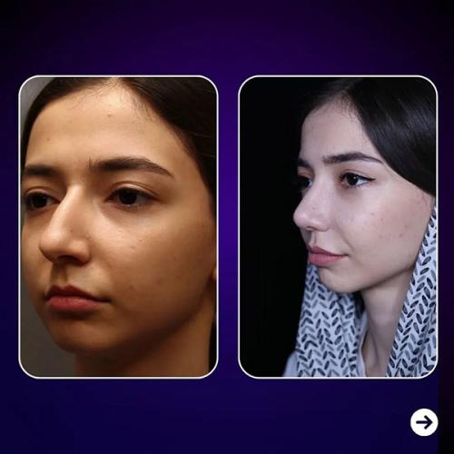 rhinoplasty-675