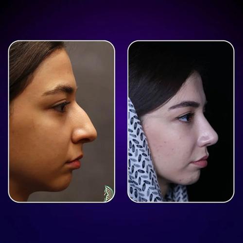 rhinoplasty-677