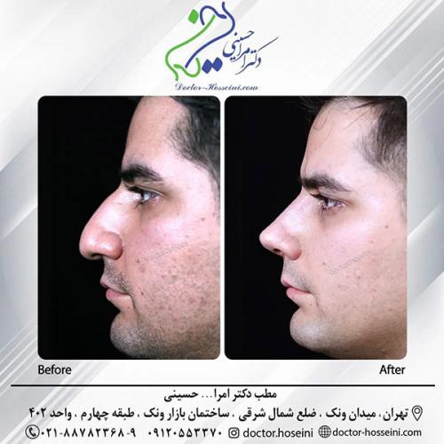 rhinoplasty-680