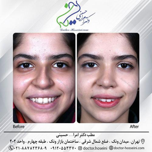 rhinoplasty-683