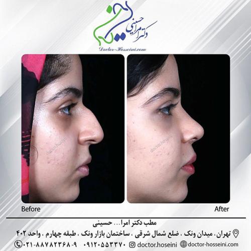 rhinoplasty-685