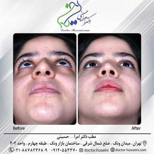 rhinoplasty-686