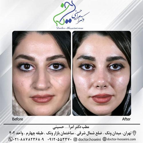 rhinoplasty-688