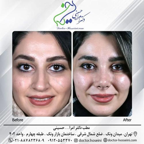 rhinoplasty-689