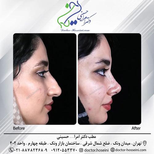 rhinoplasty-691