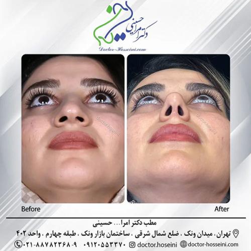 rhinoplasty-692