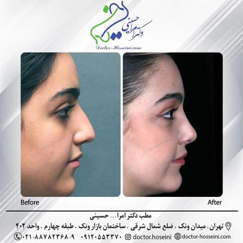 rhinoplasty-695