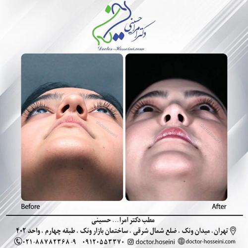 rhinoplasty-696