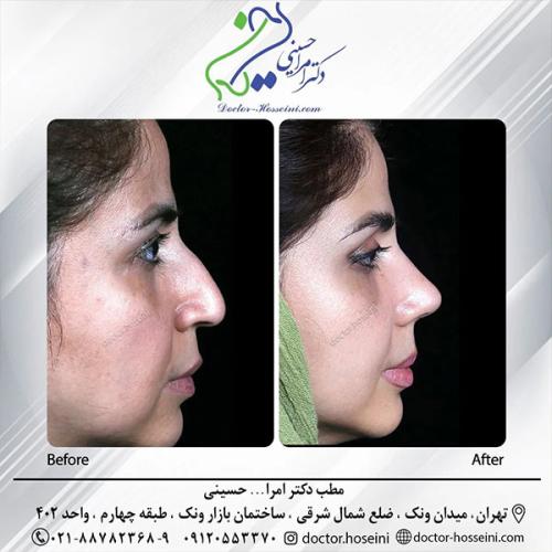 rhinoplasty-698