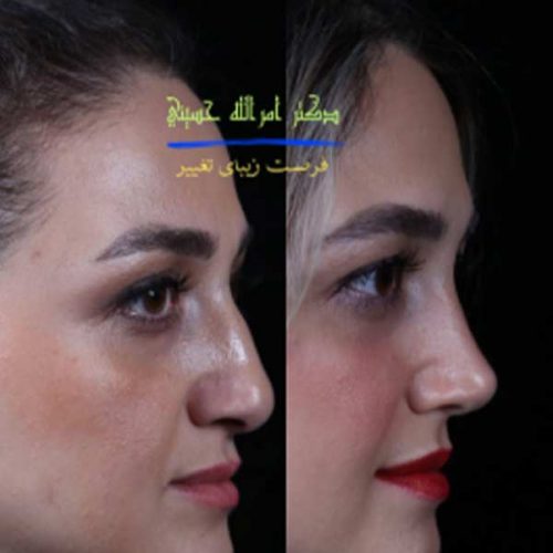 rhinoplasty686