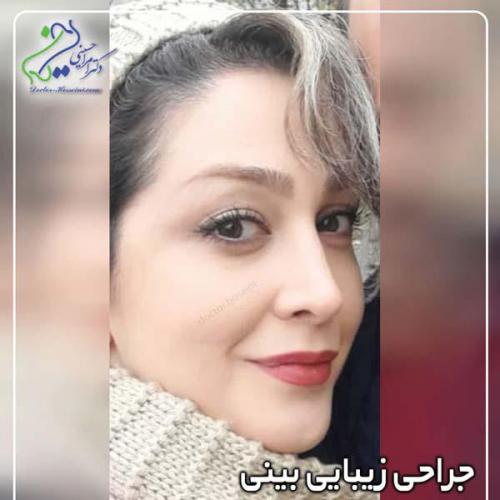 جراحی-بینی-403