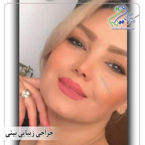 جراحی-بینی-424