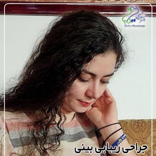 جراحی-بینی-433