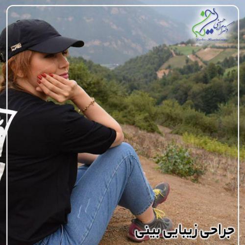 جراحی-بینی-477