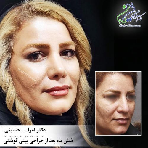 جراحی بینی 322