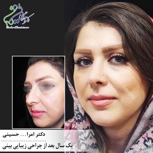 جراحی بینی 326