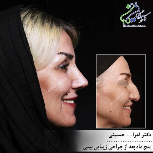 جراحی بینی 332