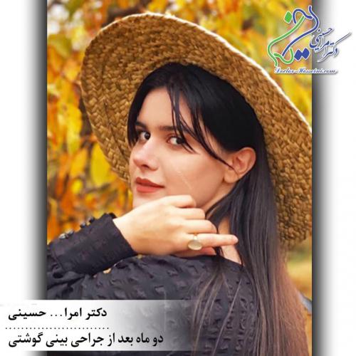 جراحی بینی 339