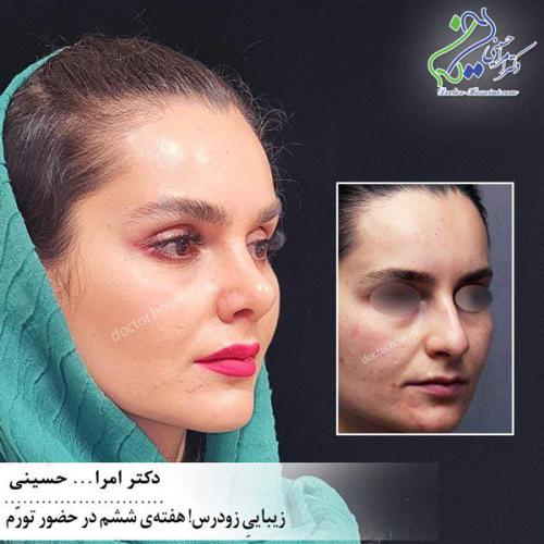 جراحی-بینی-544 (1) (1)