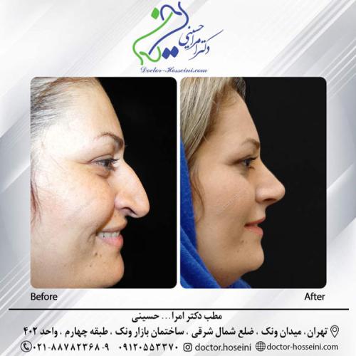 rhinoplasty-660