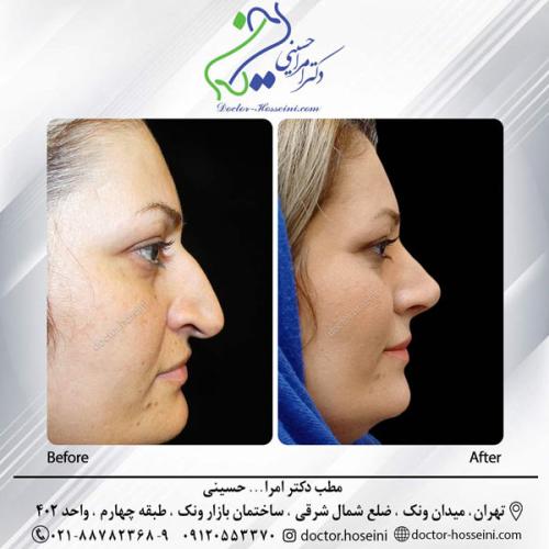 rhinoplasty-661