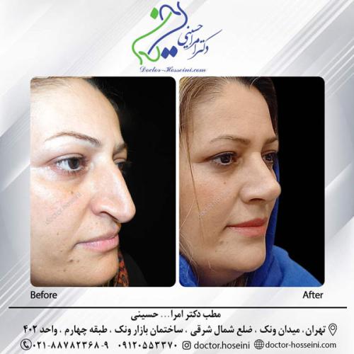 rhinoplasty-662