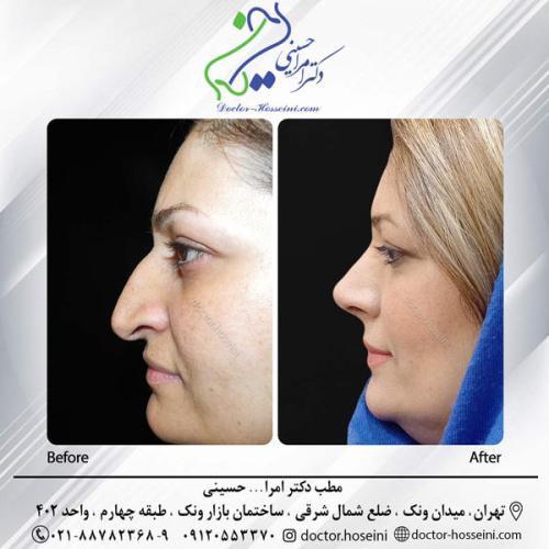 rhinoplasty-663