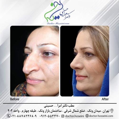 rhinoplasty-664