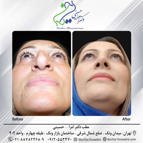 rhinoplasty-665